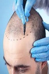 Hair Transplant in Riyadh