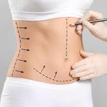 Circumferential Abdominoplasty in Riyadh