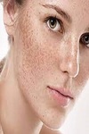 Freckles and Blemishes Removal in Riyadh
