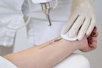 Laser Tattoo Removal in Riyadh