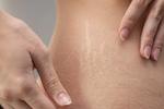 Stretch Mark Removal in Riyadh