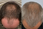 Stem Cell Hair Transplant 