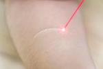 Laser Scar Removal in Riyadh