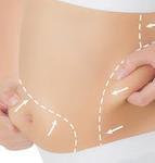 Laser Liposuction in Riyadh