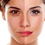 Dermal Pigmentation Treatment In Riyadh