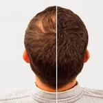 FUE Hair Transplant in Riyadh