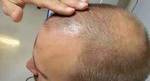 Stem Cell Hair Transplant in Riyadh