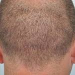 Scarless Hair Transplant in Riyadh