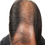 Baldness treatment for males in Riyadh