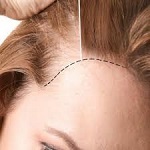Female Hair Transplant in Riyadh