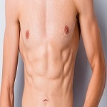 Gynecomastia Male Breast Reduction In Riyadh