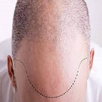 Hair Transplant in Riyadh
