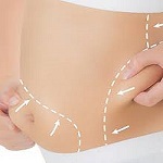 Laser Liposuction in Riyadh