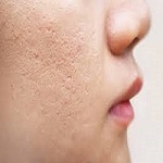 Radio Frequency for Acne Scars in Riyadh