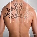 Picosure Tattoo Removal in Riyadh