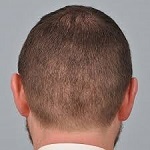 Scarless Hair Transplant in Riyadh