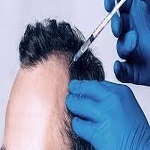 Hair Fillers in Riyadh