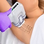 Laser Hyperhidrosis Treatment in Riyadh