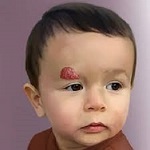Hemangioma Treatment in Riyadh