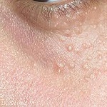 Syringoma Removal in Riyadh