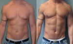 Gynecomastia Surgery in Islamabad