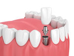 Dental implants in Islamabad