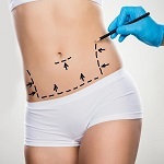 Tummy Tuck in Islamabad
