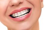 Dental Braces in Islamabad