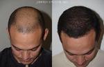 Male hair transplant Islamabad