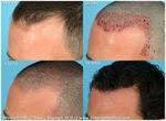 Hair transplant in Islamabad