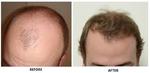 Is Hair Transplant Safe in Islamabad Pakistan?