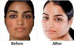 Permanent Skin Whitening in Islamabad