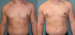 Can Gynecomastia be Removed Through Exercise Without Surgery.