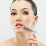Pimples Treatment  in Islamabad