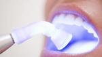 How Does Laser Teeth Whitening Work in Islamabad 