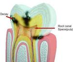 Root Canal Treatment in Islamabad