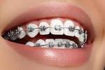 Teeth braces cost in pakistan islamabad