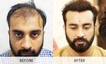 What Is The Right Time To Get a Hair Transplant in Islamabad