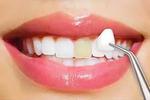 Dental Veneers treatment in Islamabad