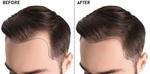 Limitations of Donor in hair transplant in Dubai