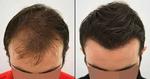 Hair transplant  before and after results