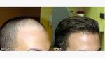 Hair transplant  clinic in dubai 
