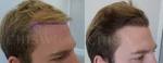 hair transplant Effective Treatment For Male Pattern Baldness