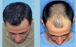Hair Transplant Surgery
