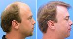 Factors to Consider Before Hair Transplant