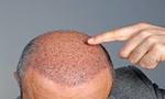 Hair Transplant Cost in Dubai