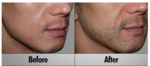 Beard Hair Transplant in Dubai