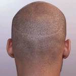 FUT Hair Transplant in Dubai 