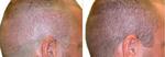 FUE Hair Transplant in Dubai