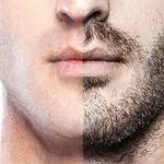 Mustache Hair Transplant in Dubai
